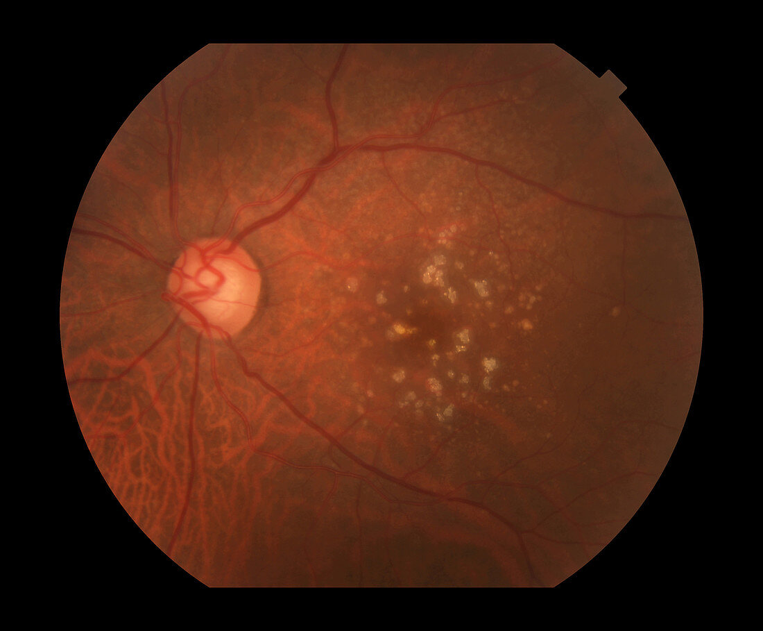 Dry Age-Related Macular Degeneration