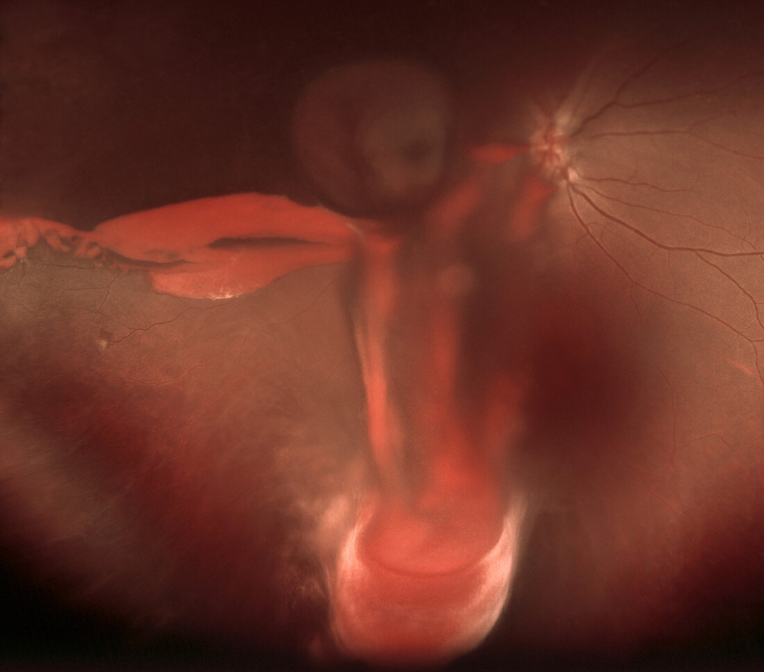 Submacular Hemorrhage