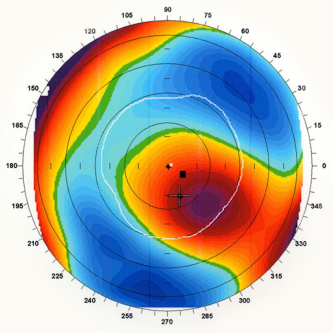 Astigmatism,Ophthalmic Medicine