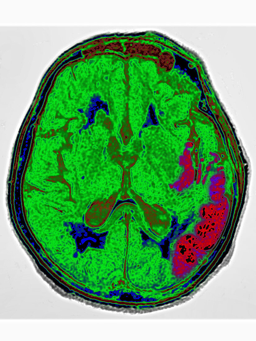 Stroke,Left Hemisphere of Brain