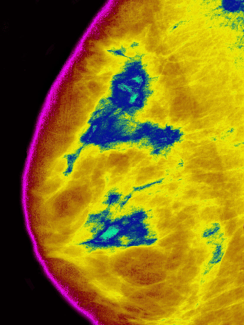 Breast Cancer,Mammogram