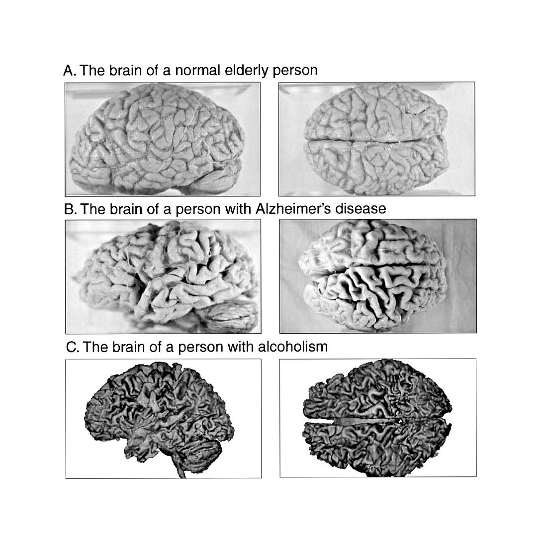 Normal,Alzheimer and Alcoholic Brains