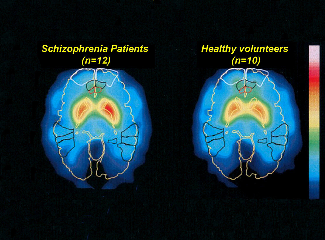 Schizophrenia and Normal Brain,PET Scans