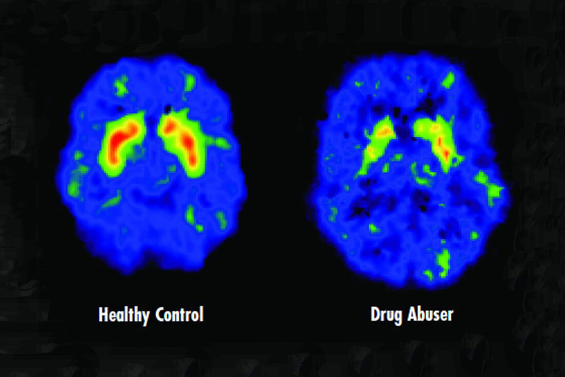 Healthy and Drug Abuser Brains,PET Scans
