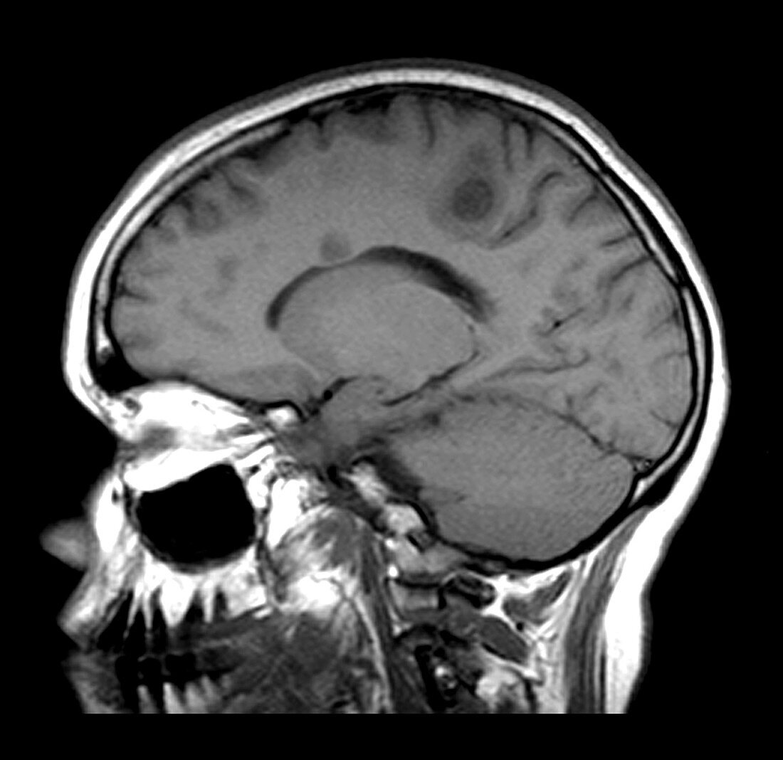 Hypointense Multiple Sclerosis Plaques