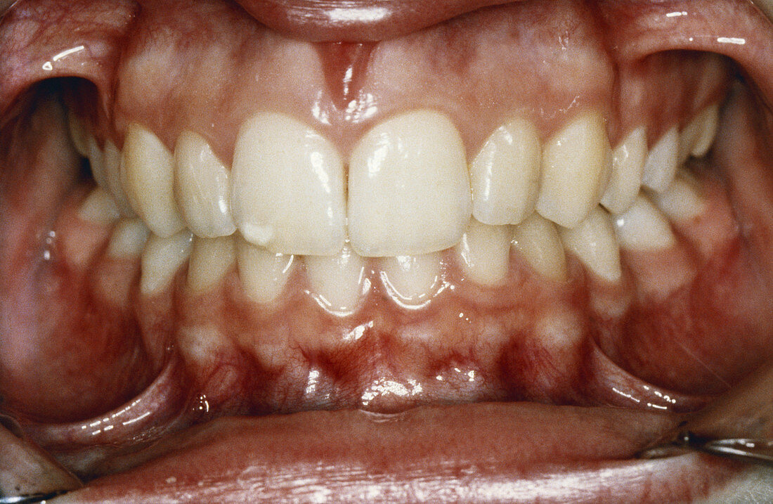 Prominent Teeth After Treatment