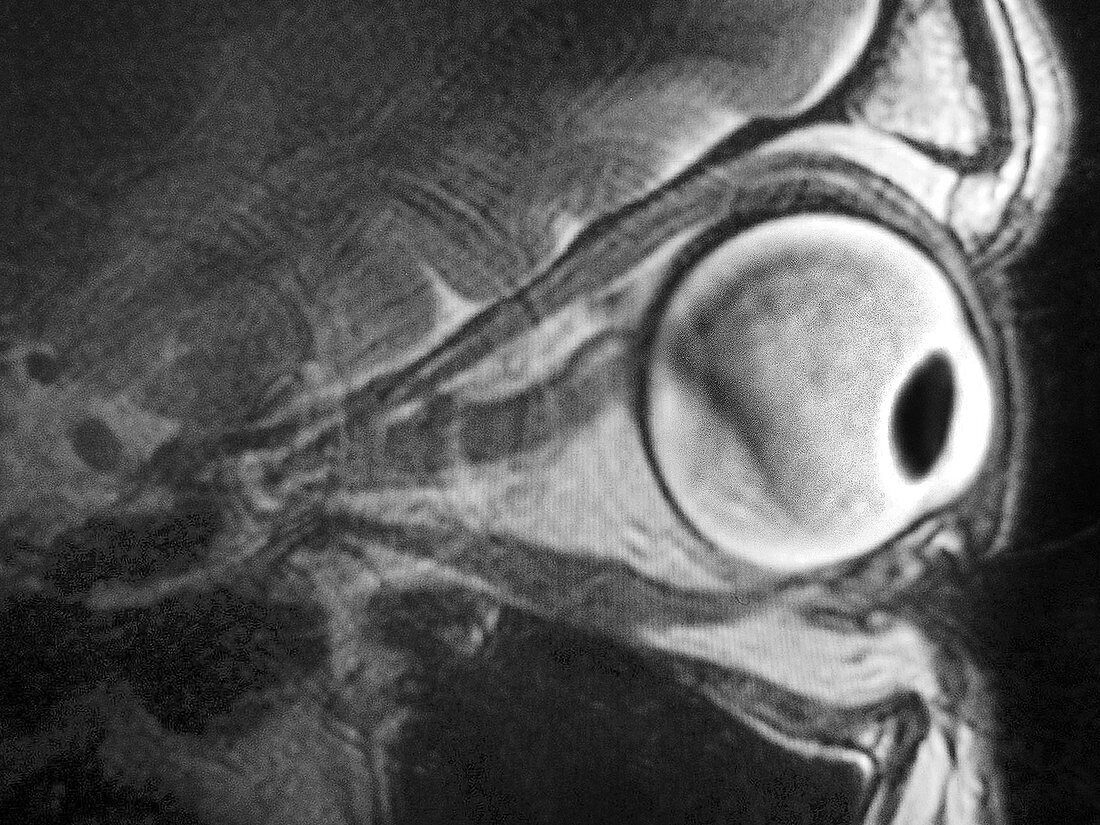 Retinal Detachment,MRI