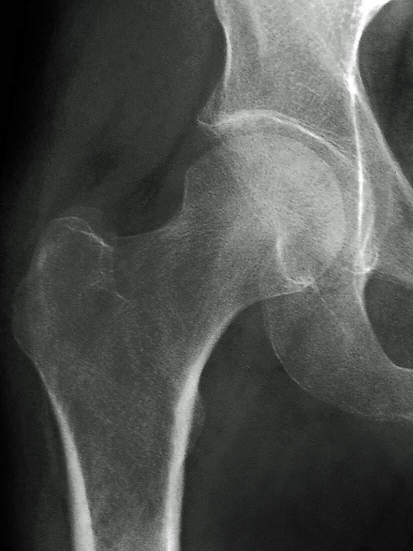 Normal Hip,X-ray