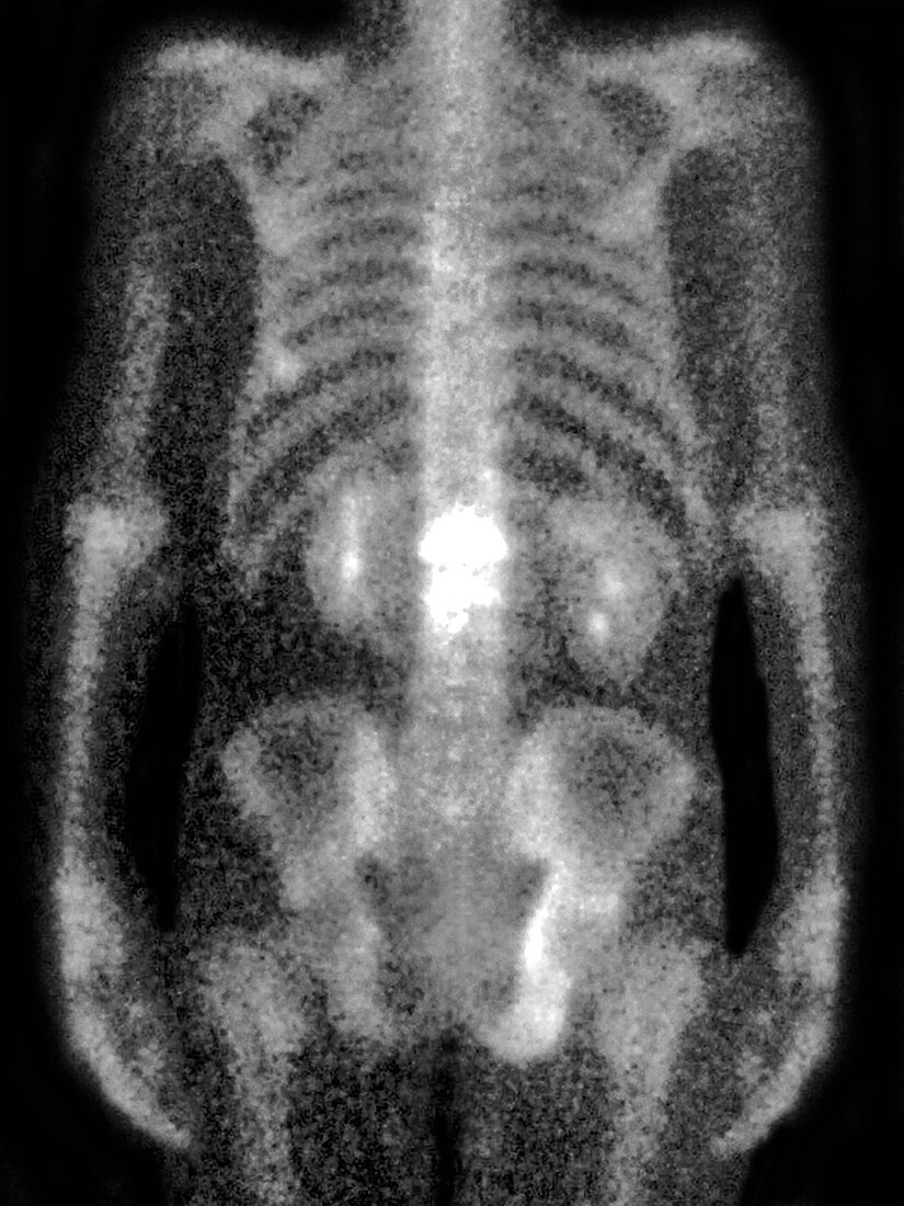 Osteoporosis,Scintigraphy