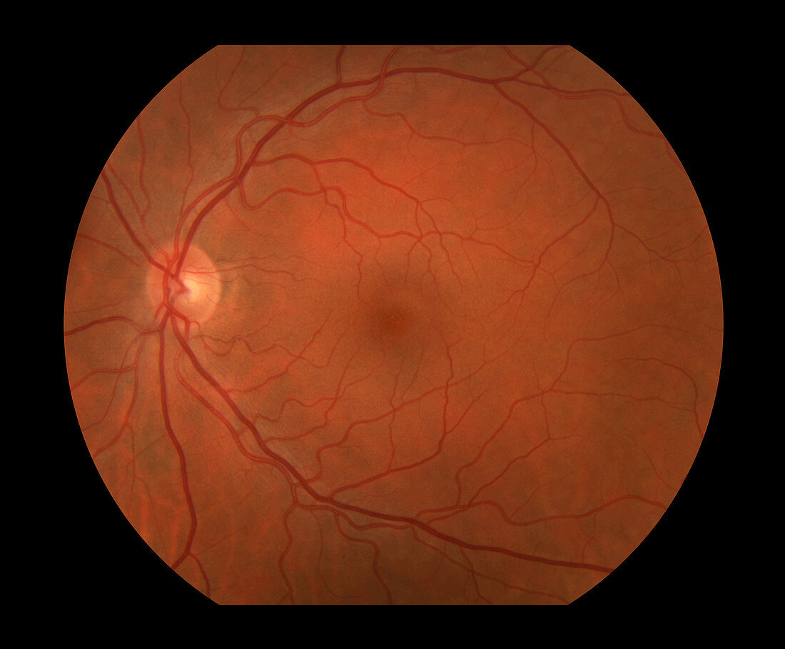 Diabetic Retinopathy,Healthy,1 of 5