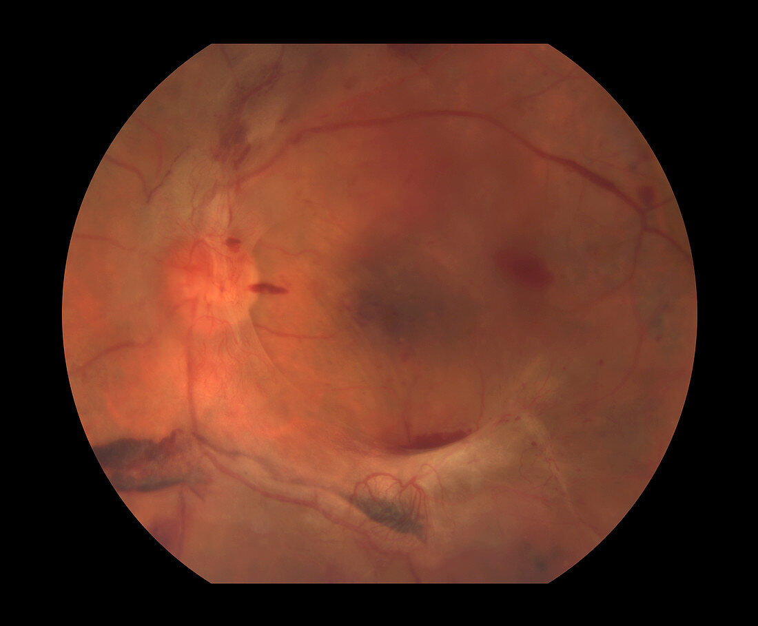 Diabetic Retinopathy,5 of 5