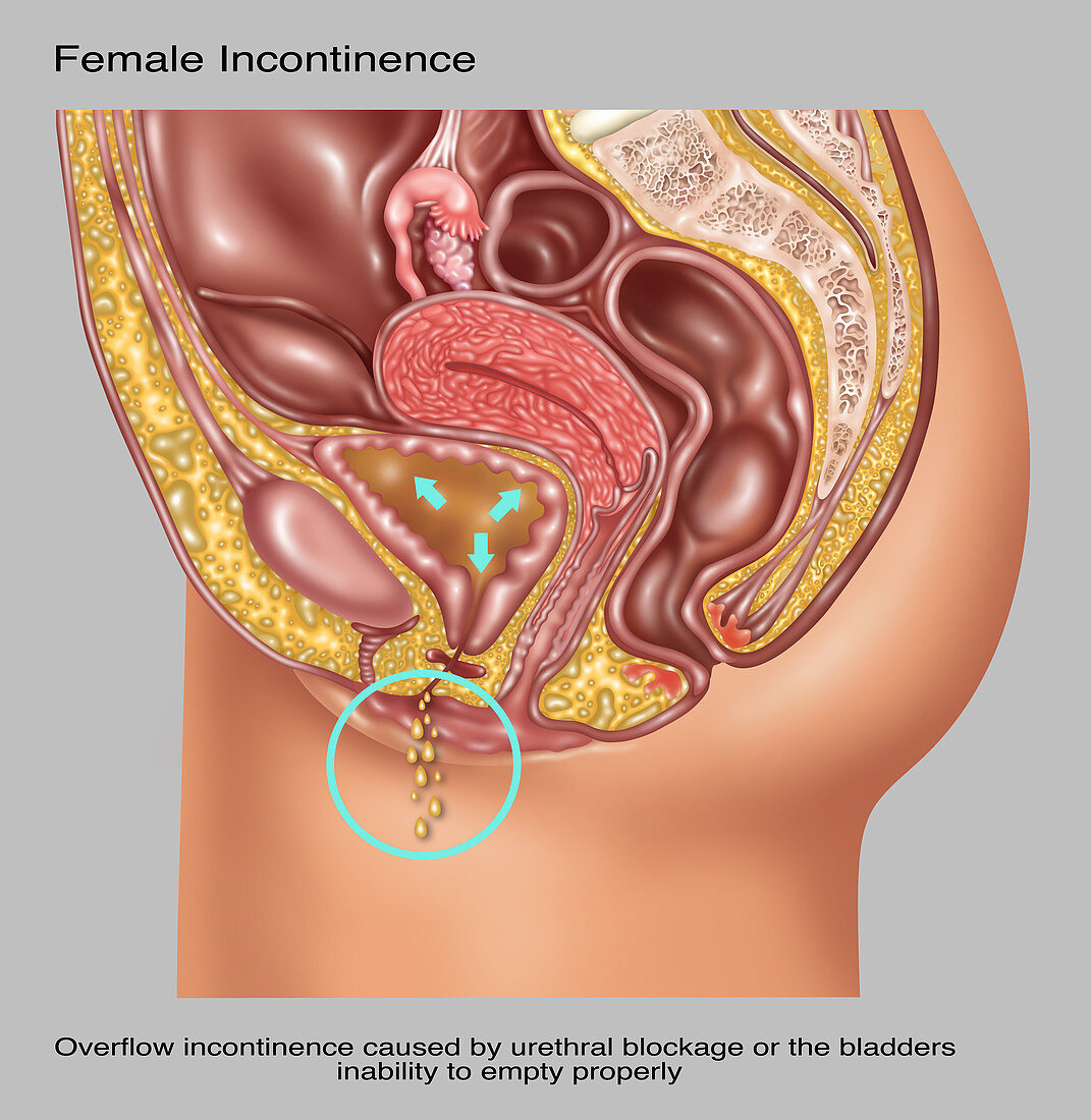 Overflow Incontinence in Female Anatomy