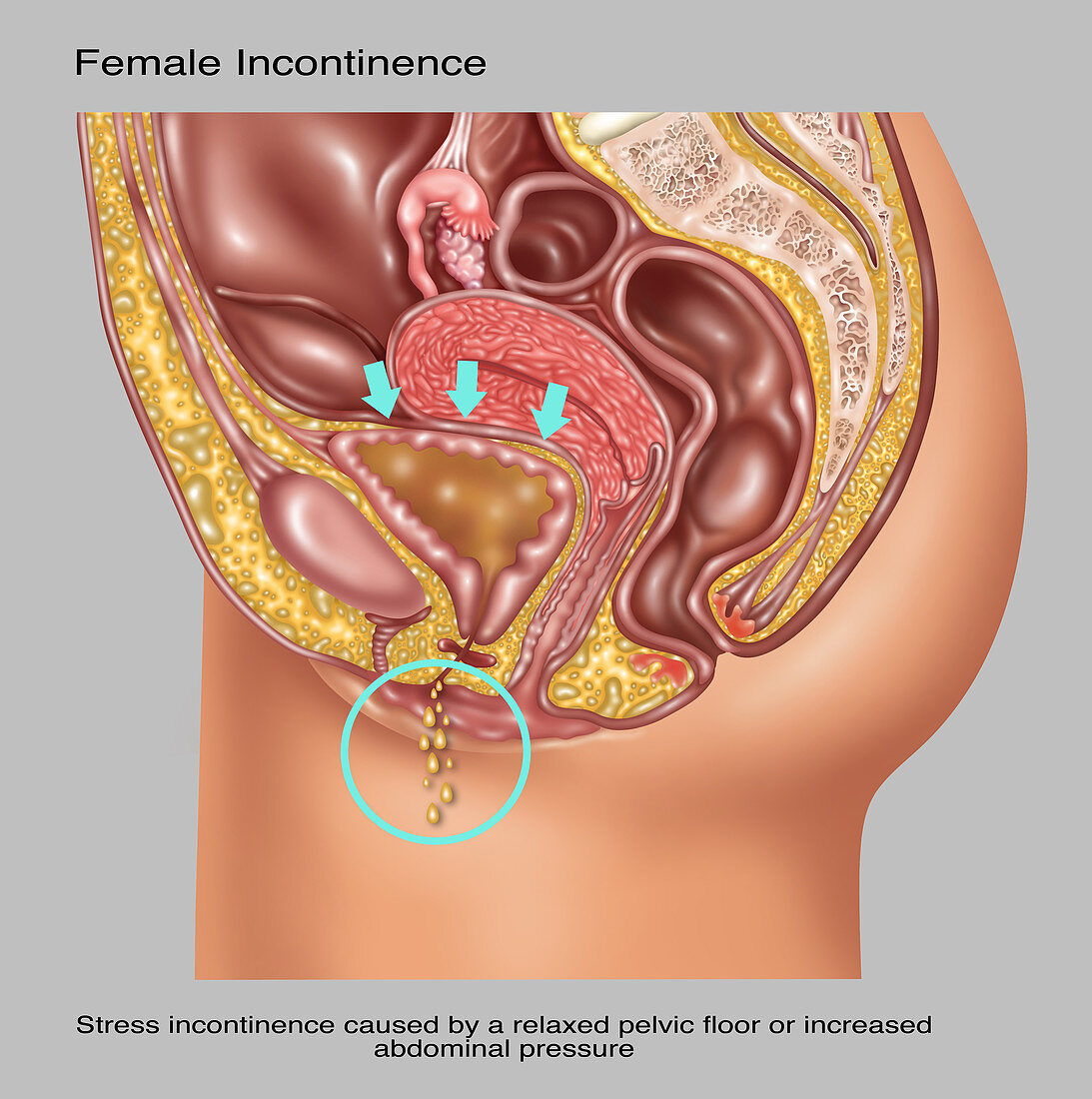Stress Incontinence in Female Anatomy