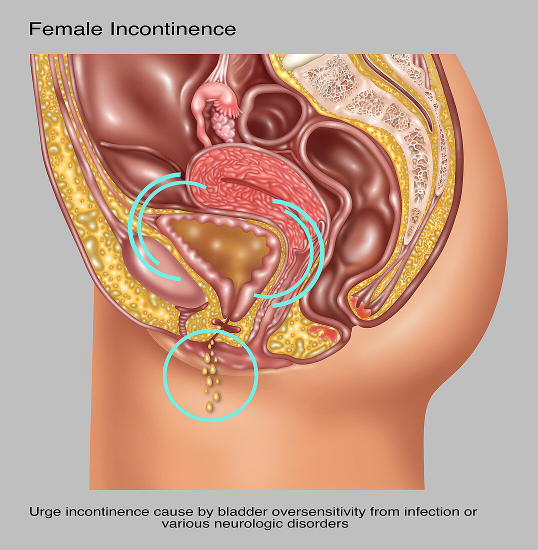 Urge Incontinence in Female Anatomy
