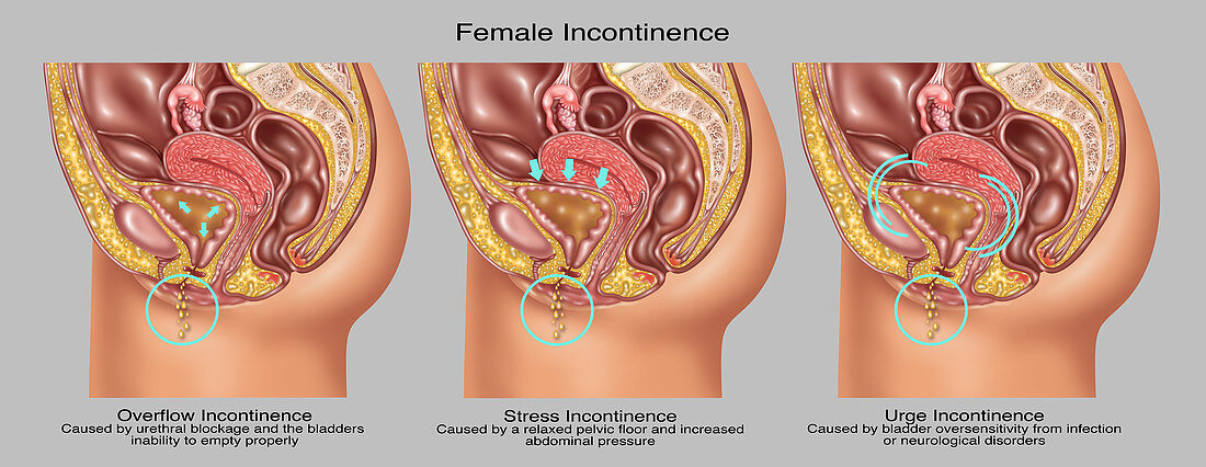 Types of Incontinence in Female Anatomy