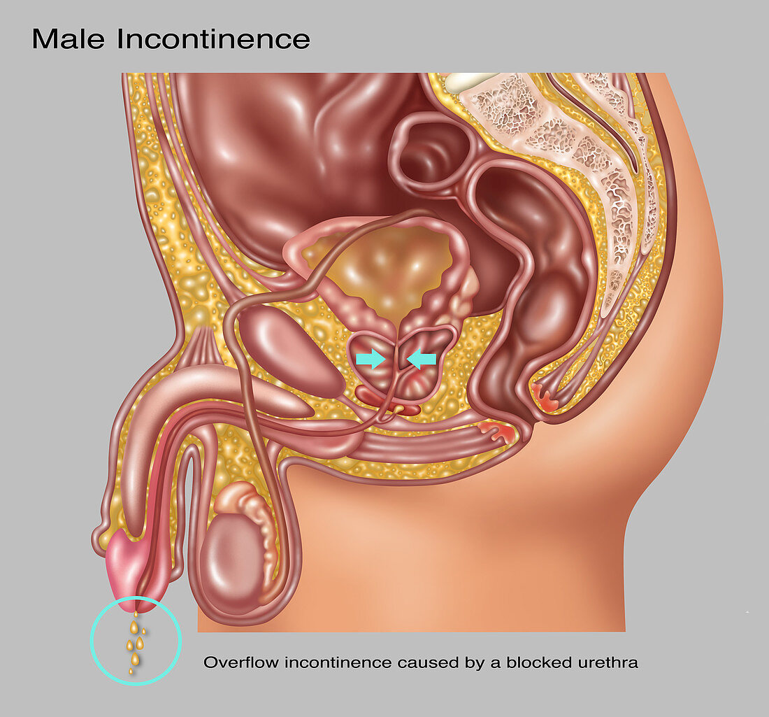 Overflow Incontinence in Male Anatomy