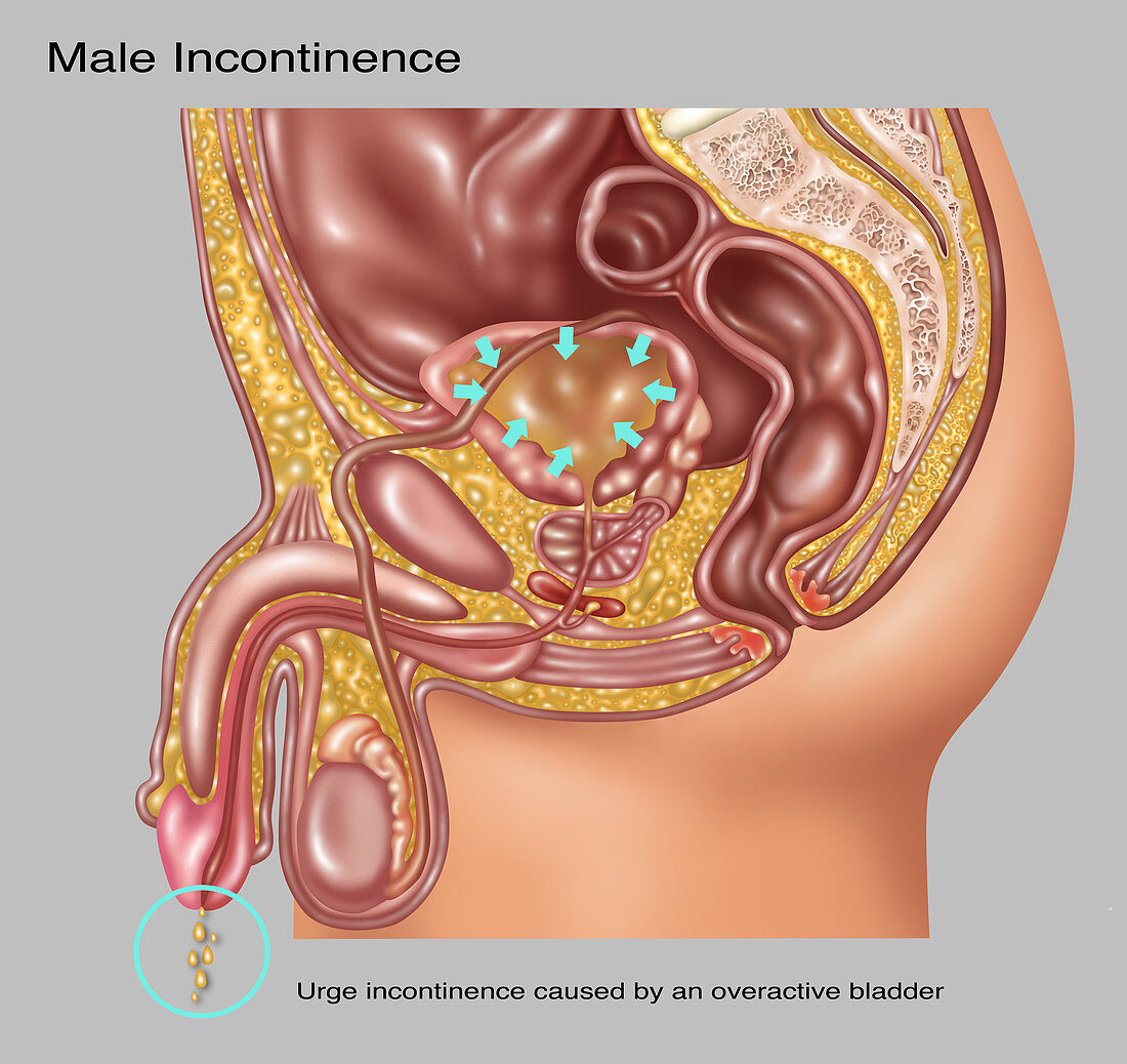 Urge Incontinence in Male Anatomy