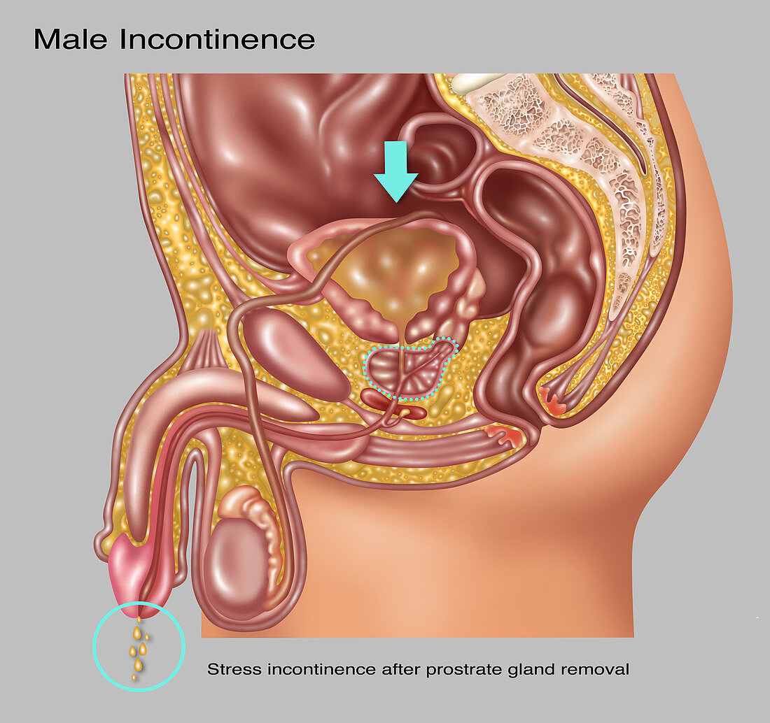 Stress Incontinence in Male Anatomy