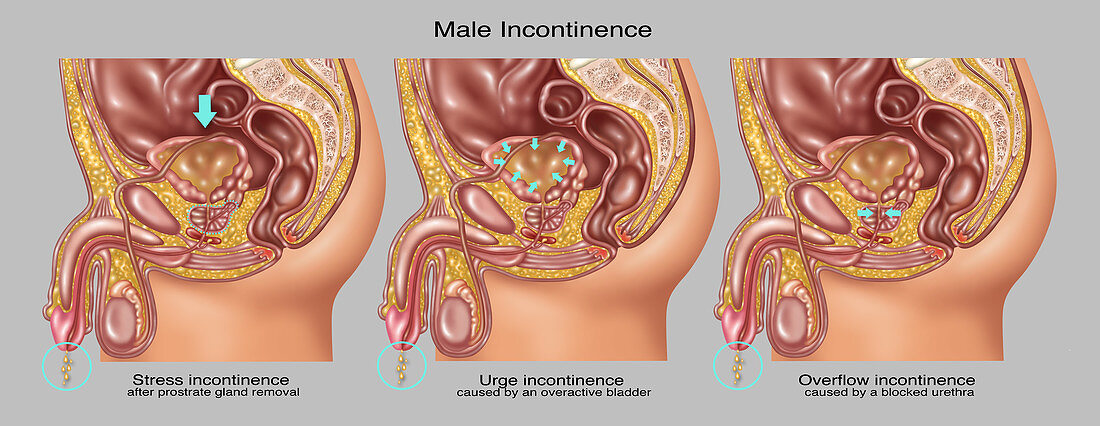 Types of Incontinence in Male Anatomy