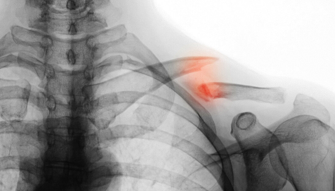 Clavicle Fracture,X-ray