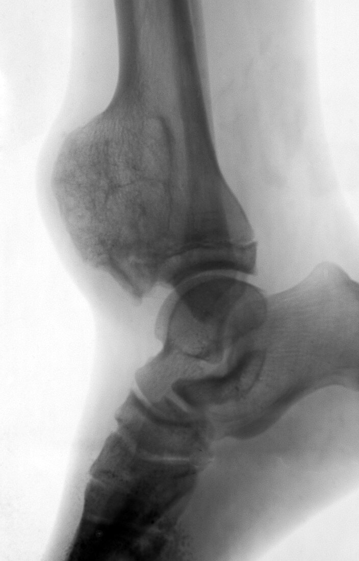 Tumour in Distal Tibia,X-ray