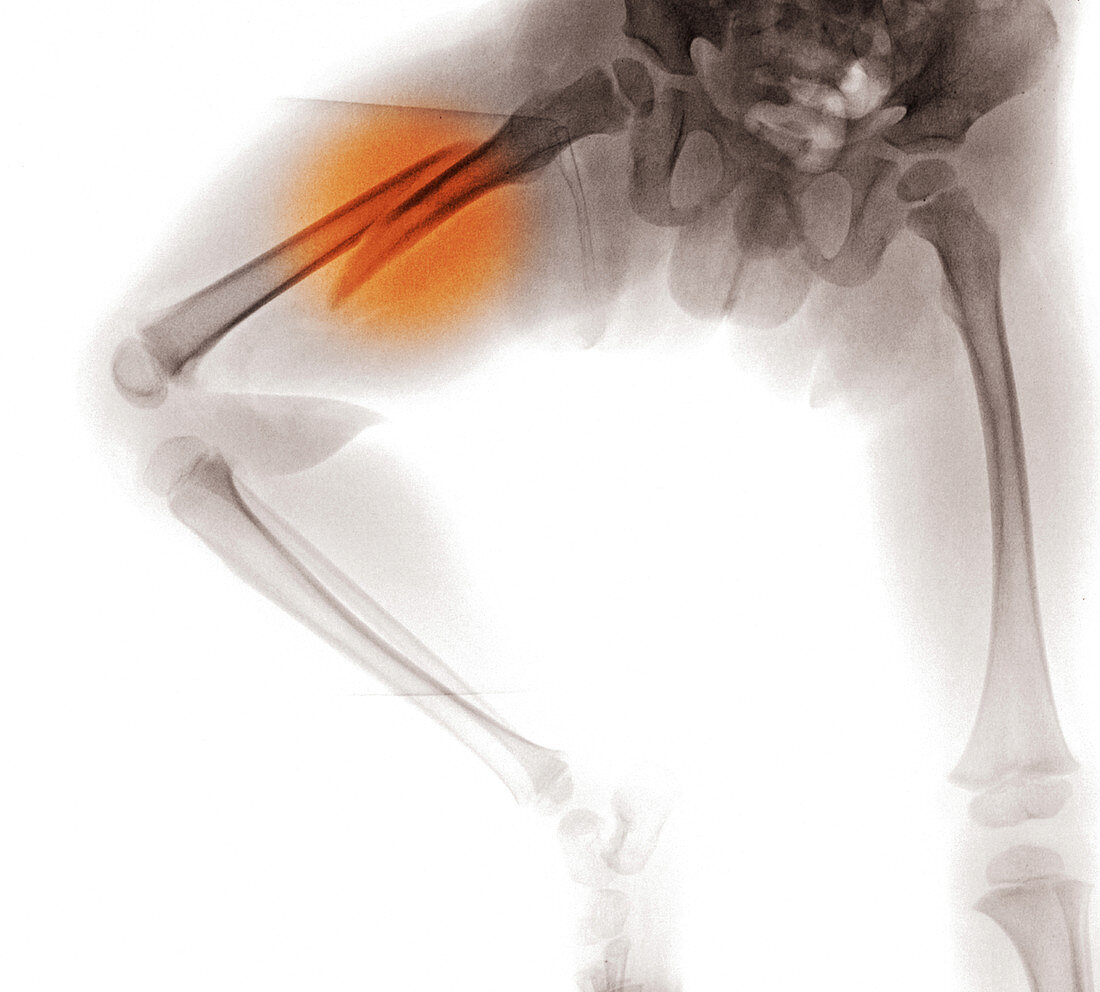 Femur Fracture,X-ray