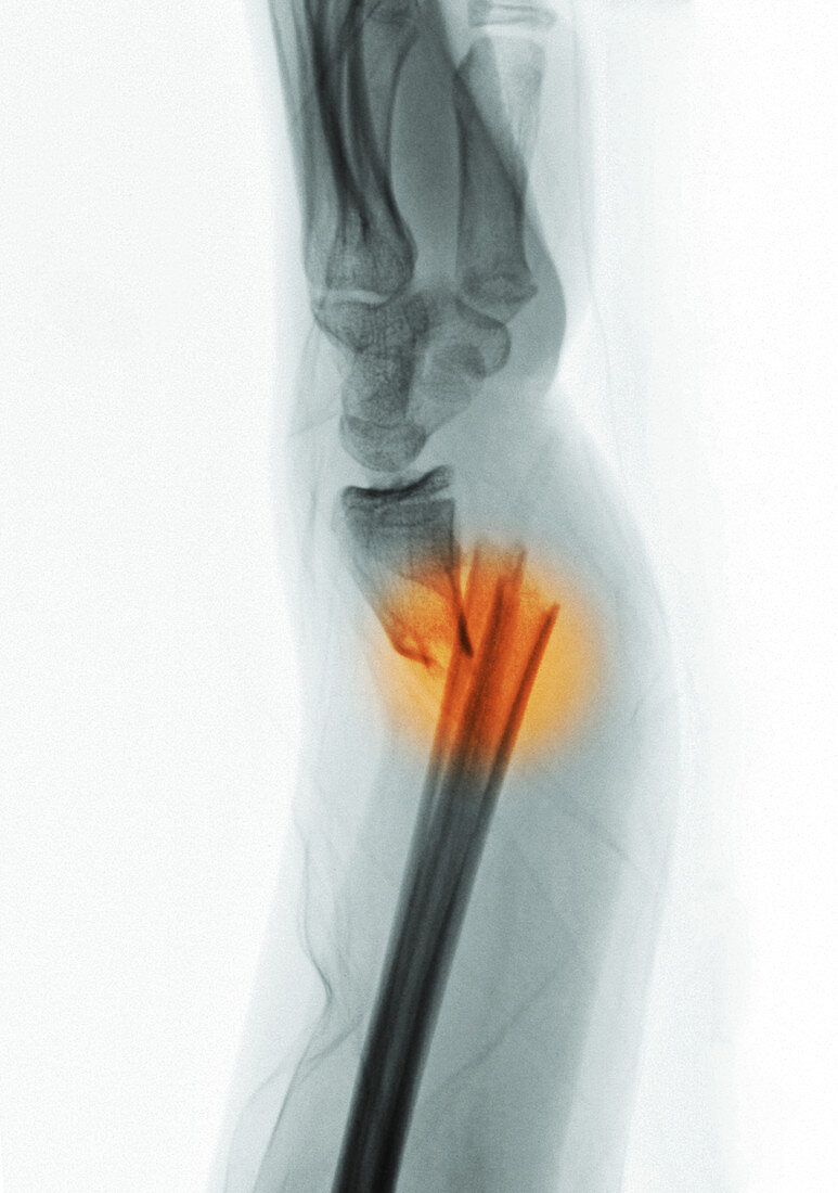Forearm Fracture,X-ray