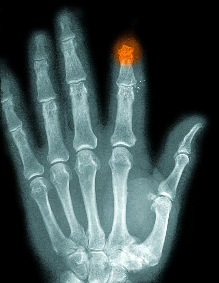 Finger Amputation,X-ray