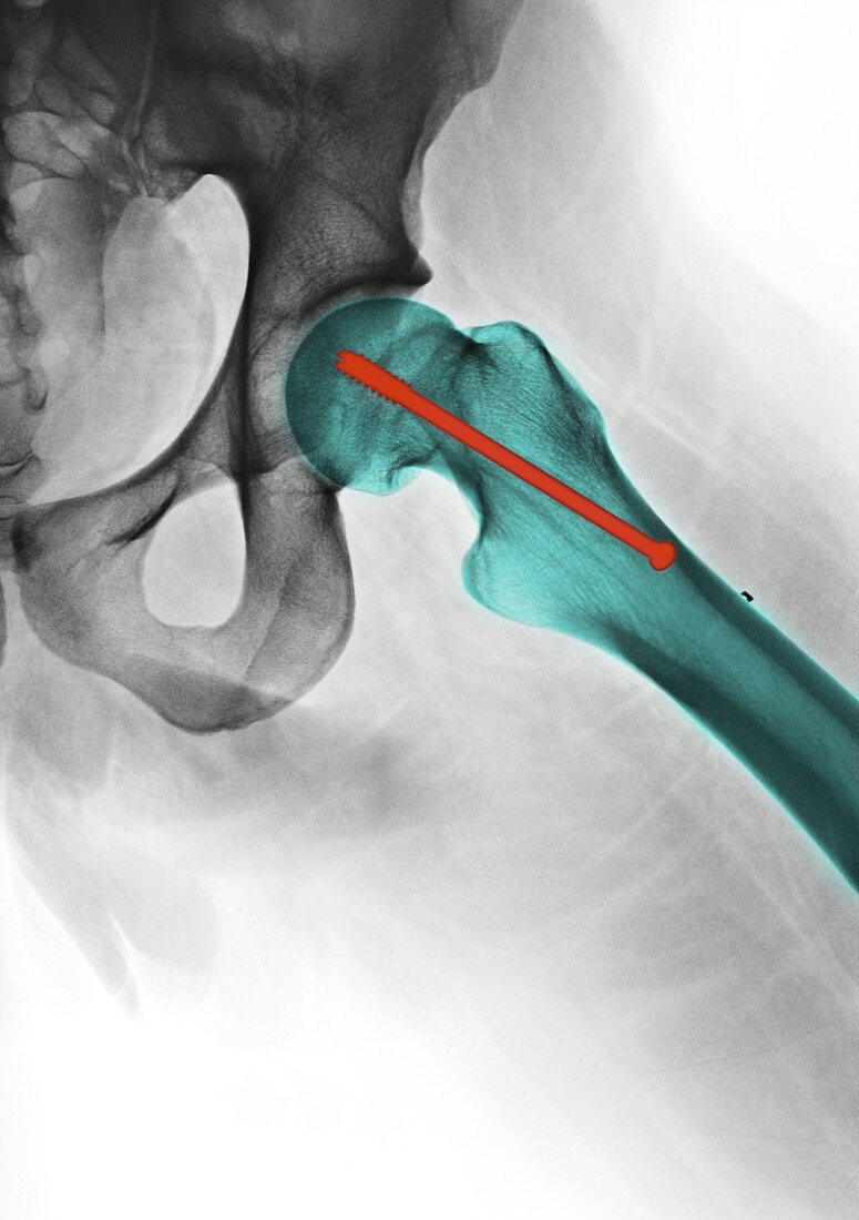 Pin in Hip,X-ray