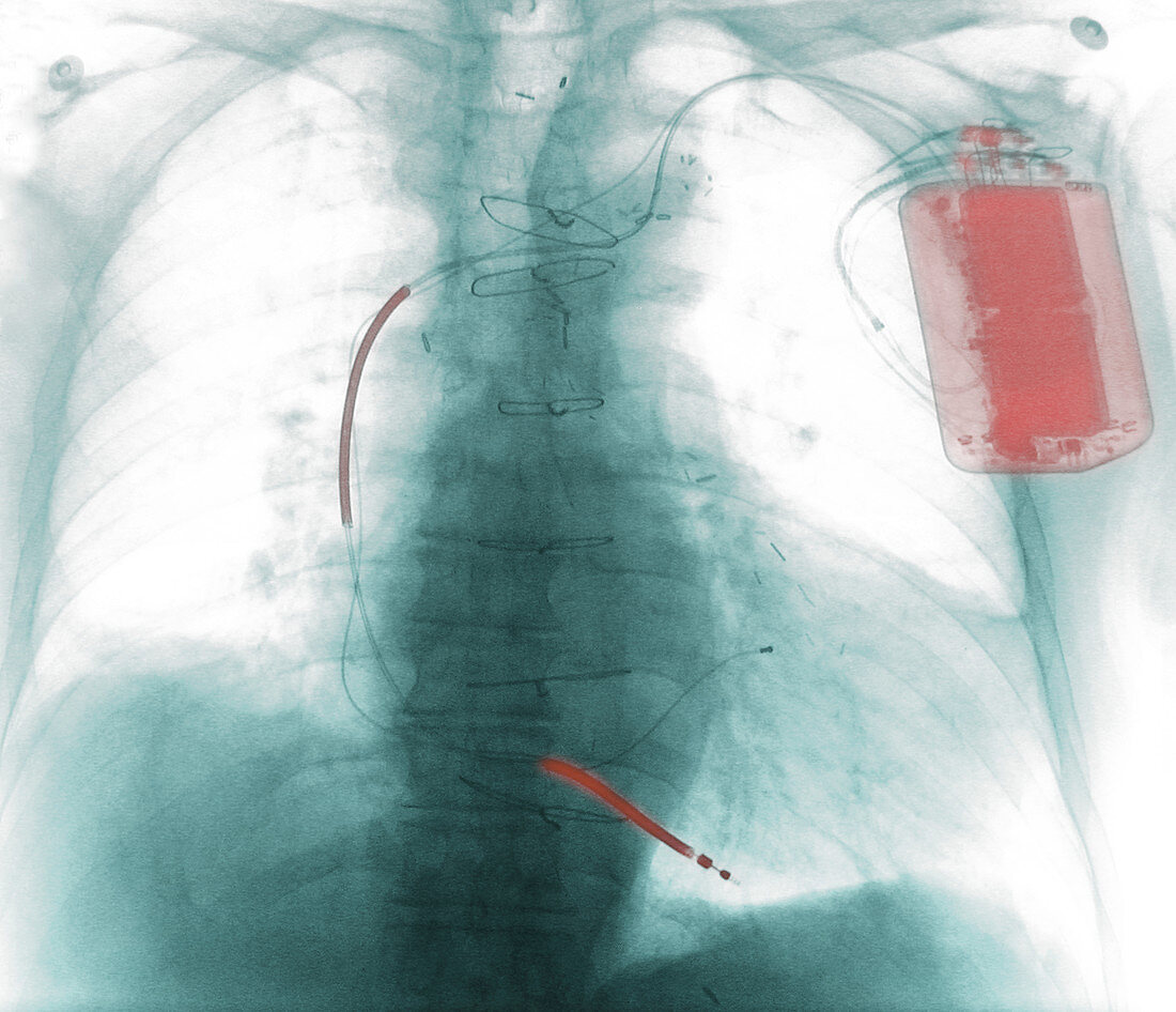 Implanted Defibrillator,X-ray