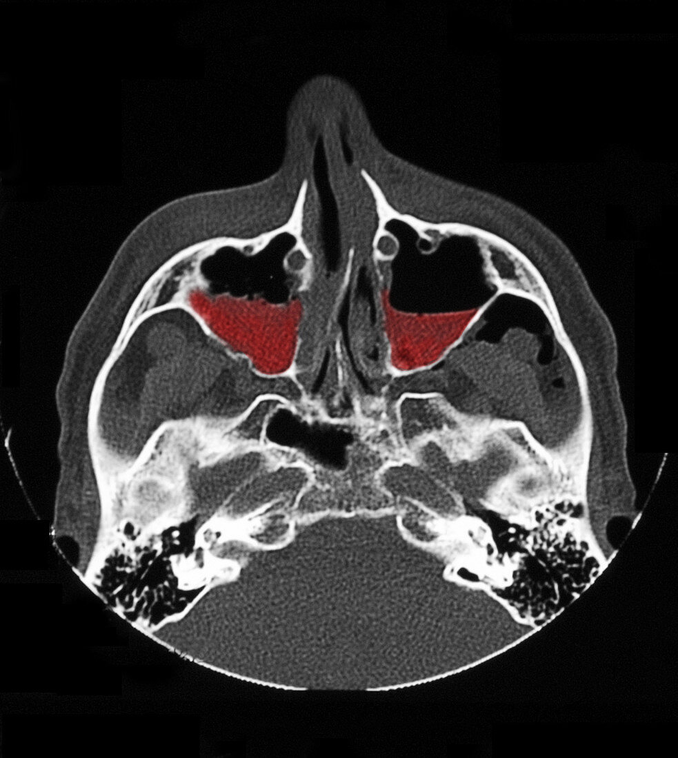 Maxillary Sinus Fractures,CT