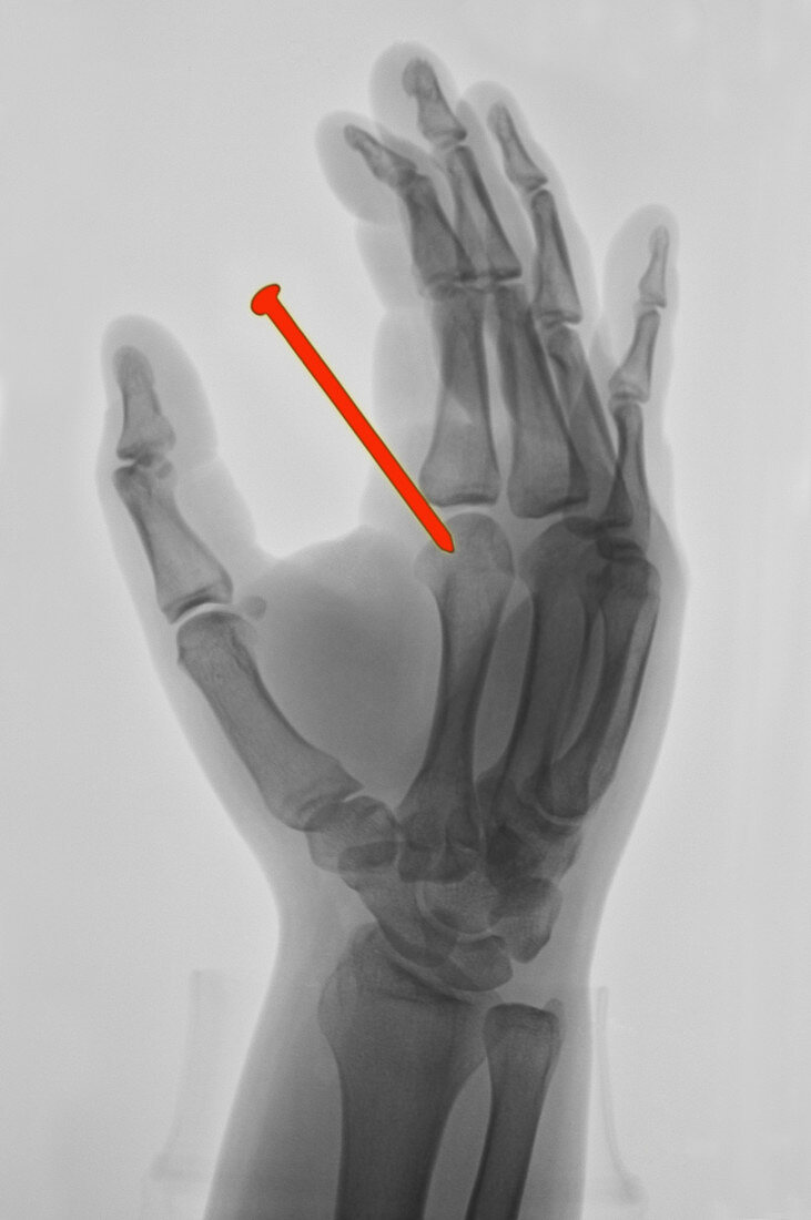 Nail in Hand,X-ray