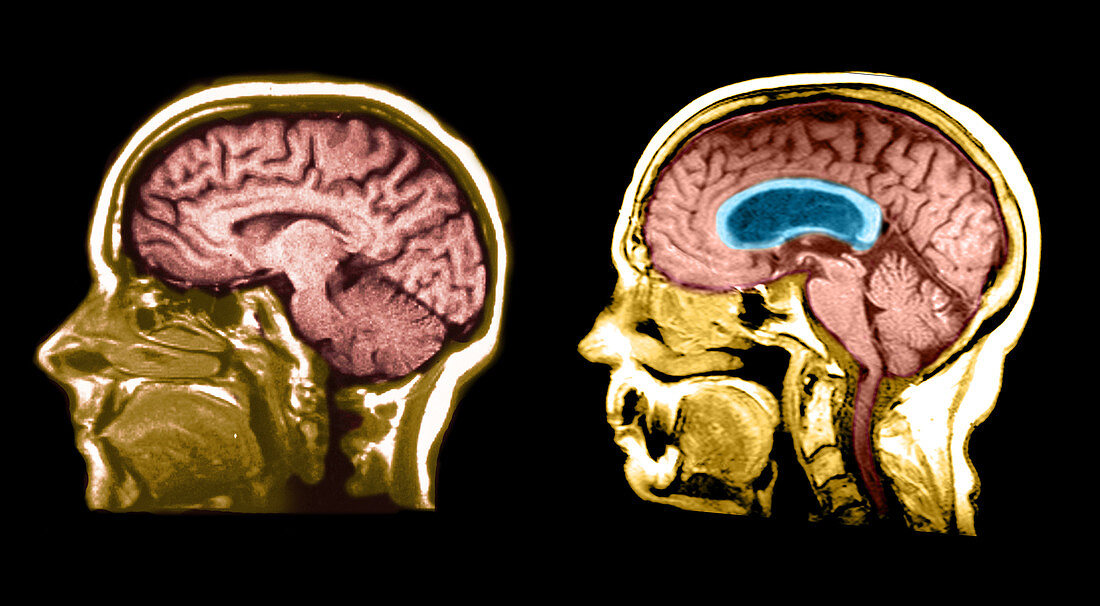 MRI of Hydrocephalic Brain