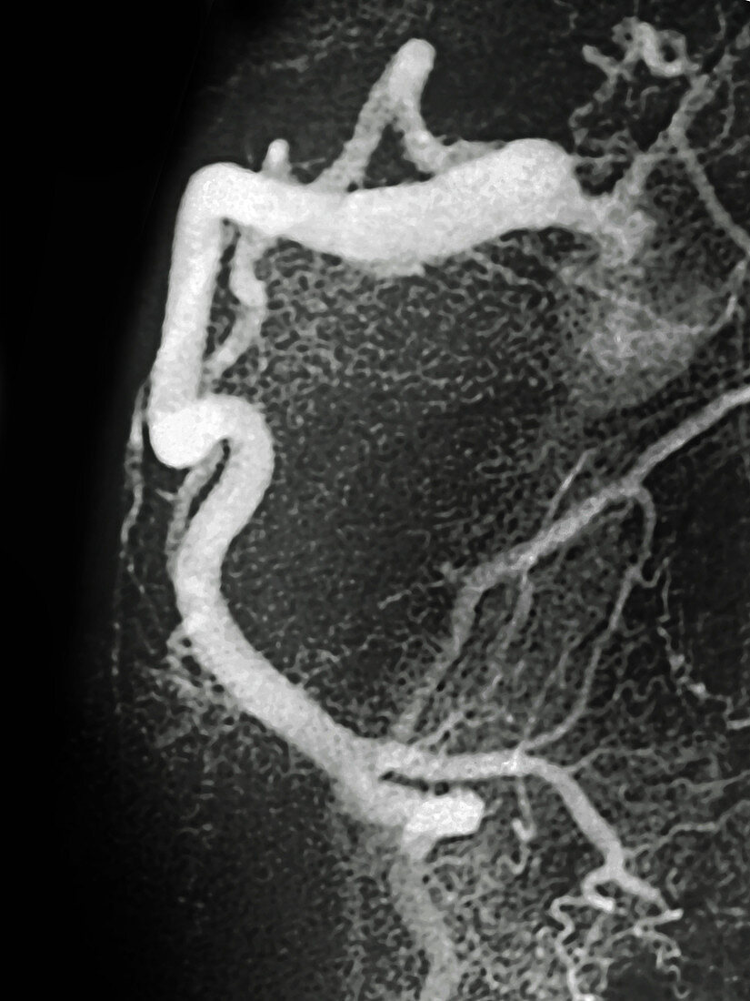 Right Coronary Artery,LM