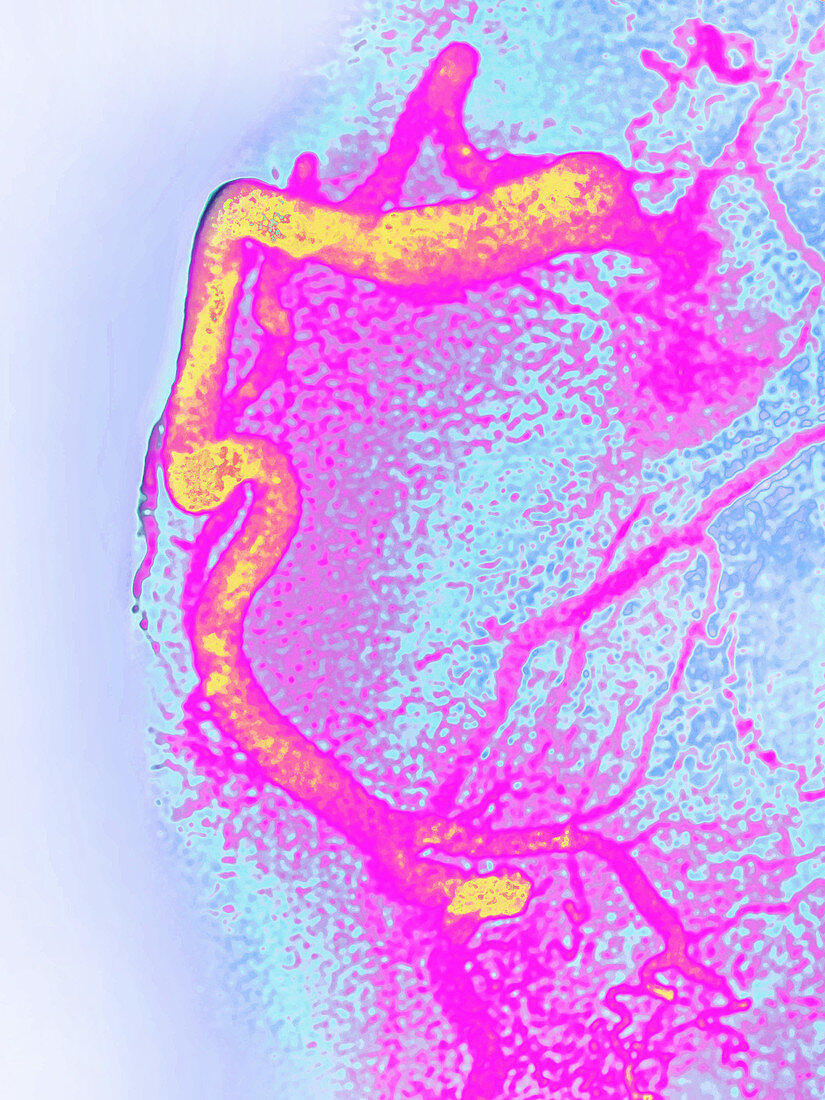 Right Coronary Artery,LM