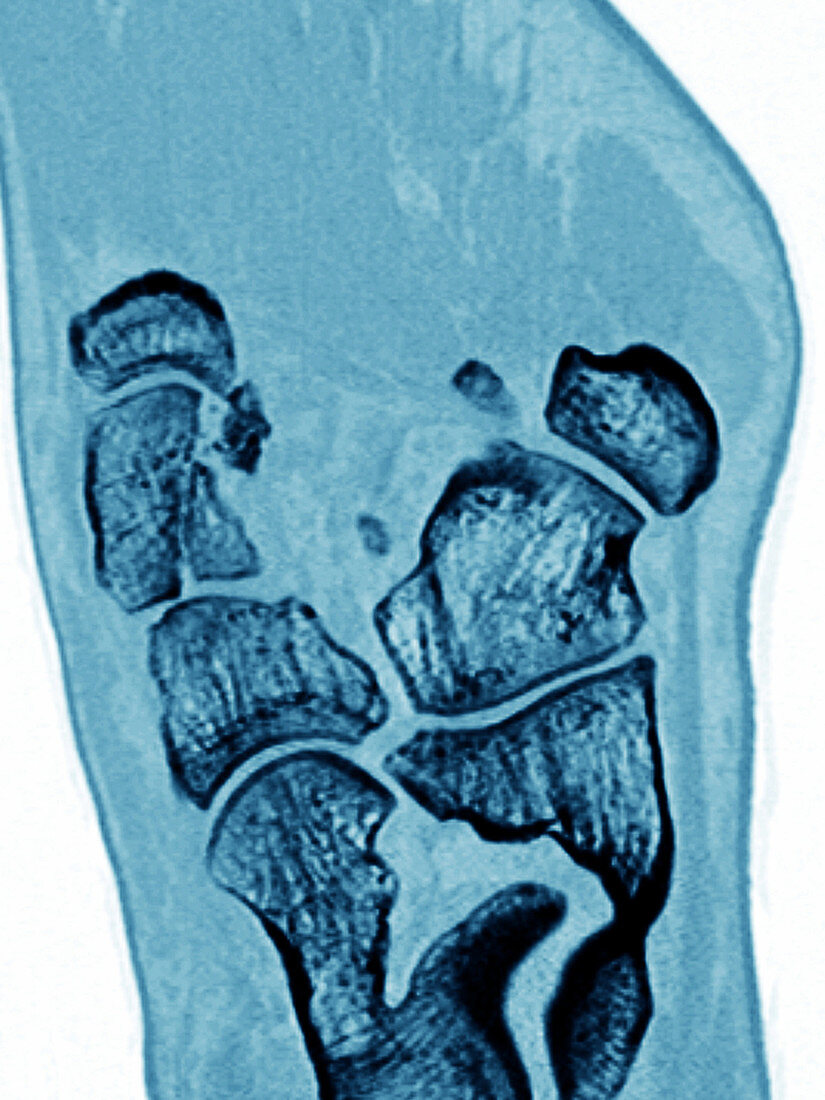 Cuneiform Bone Fracture,CT Scan