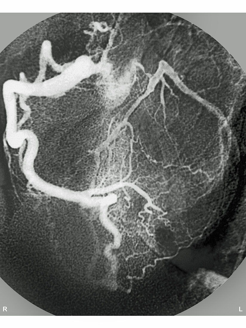 Myocardial Infarction,Angiogram