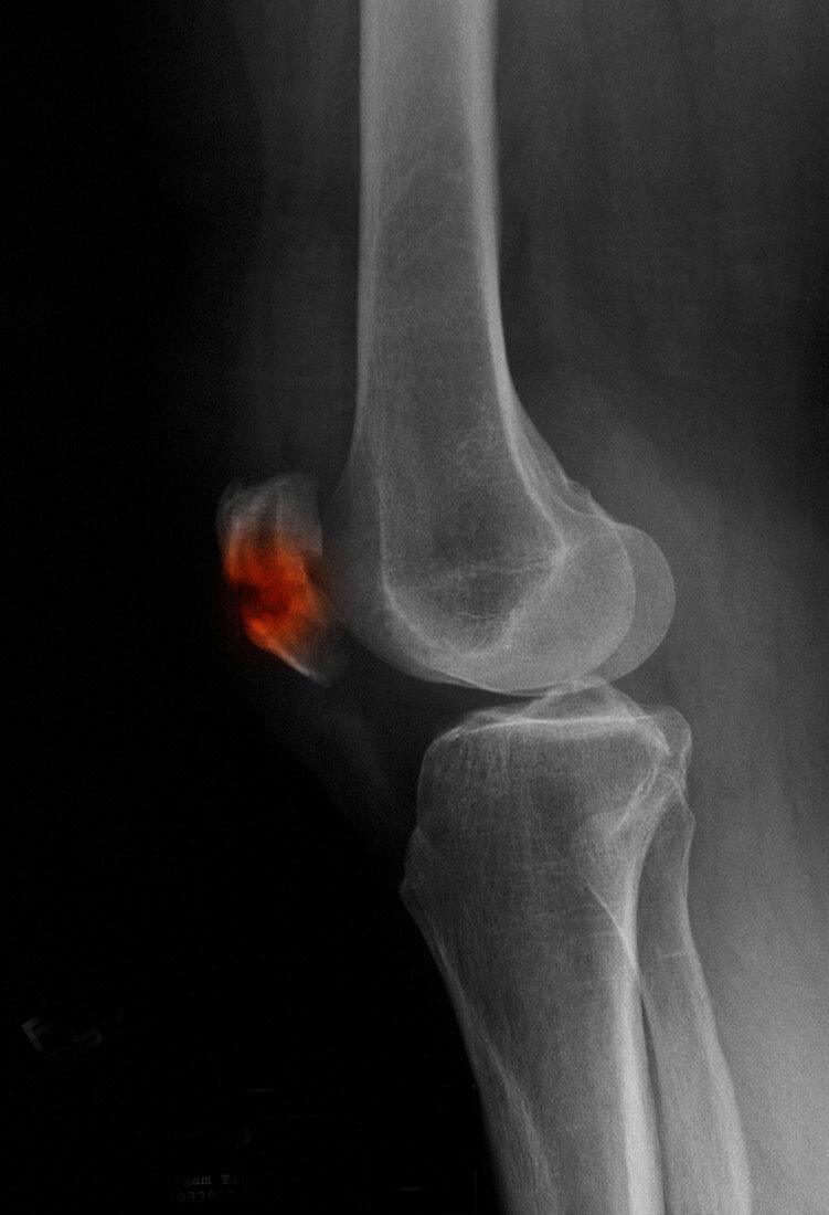 Patella Fracture,X-ray