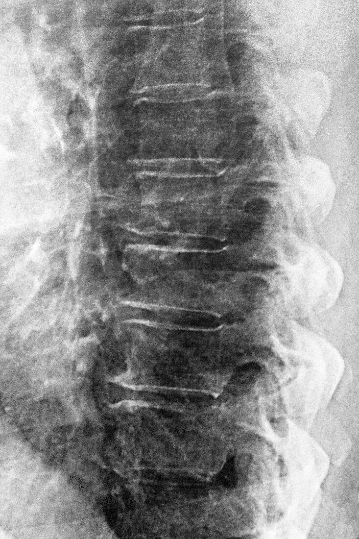 Degenerative disc disease,X-ray
