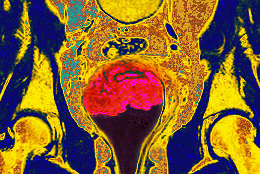 Cervical Cancer,MRI