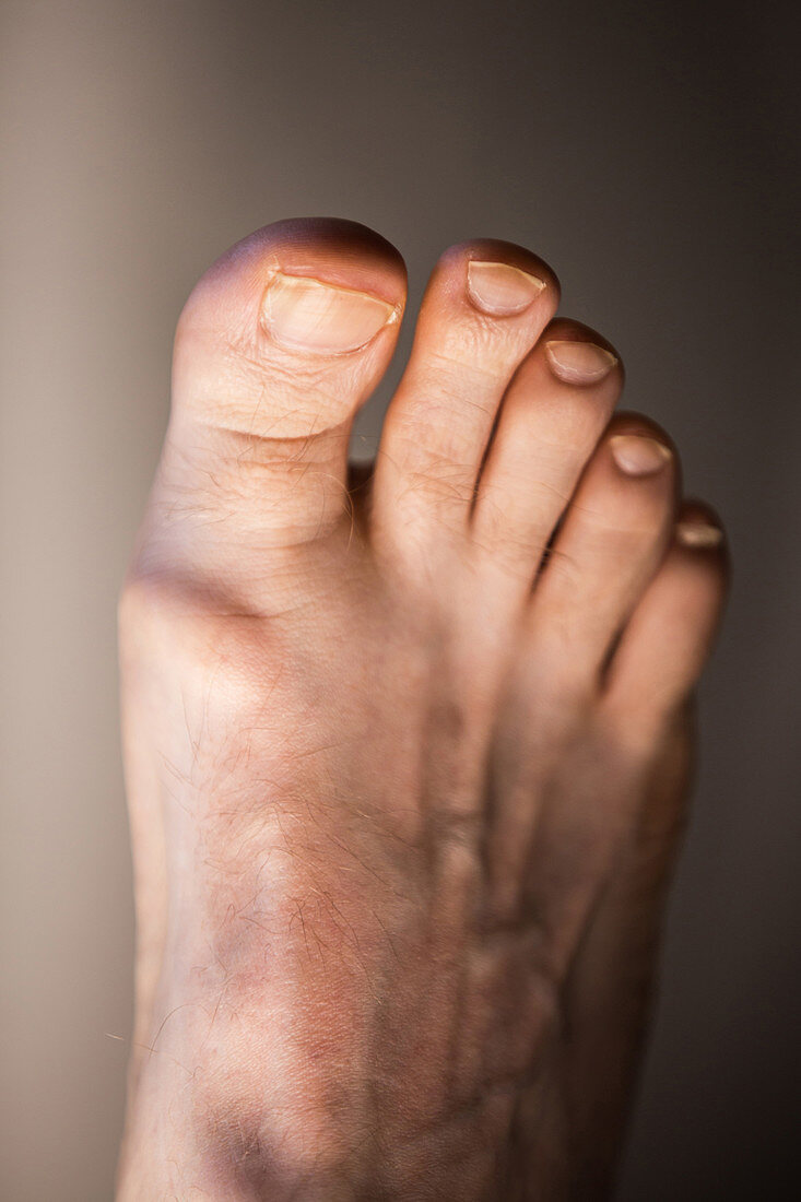 Osteoarthritis of Big Toe