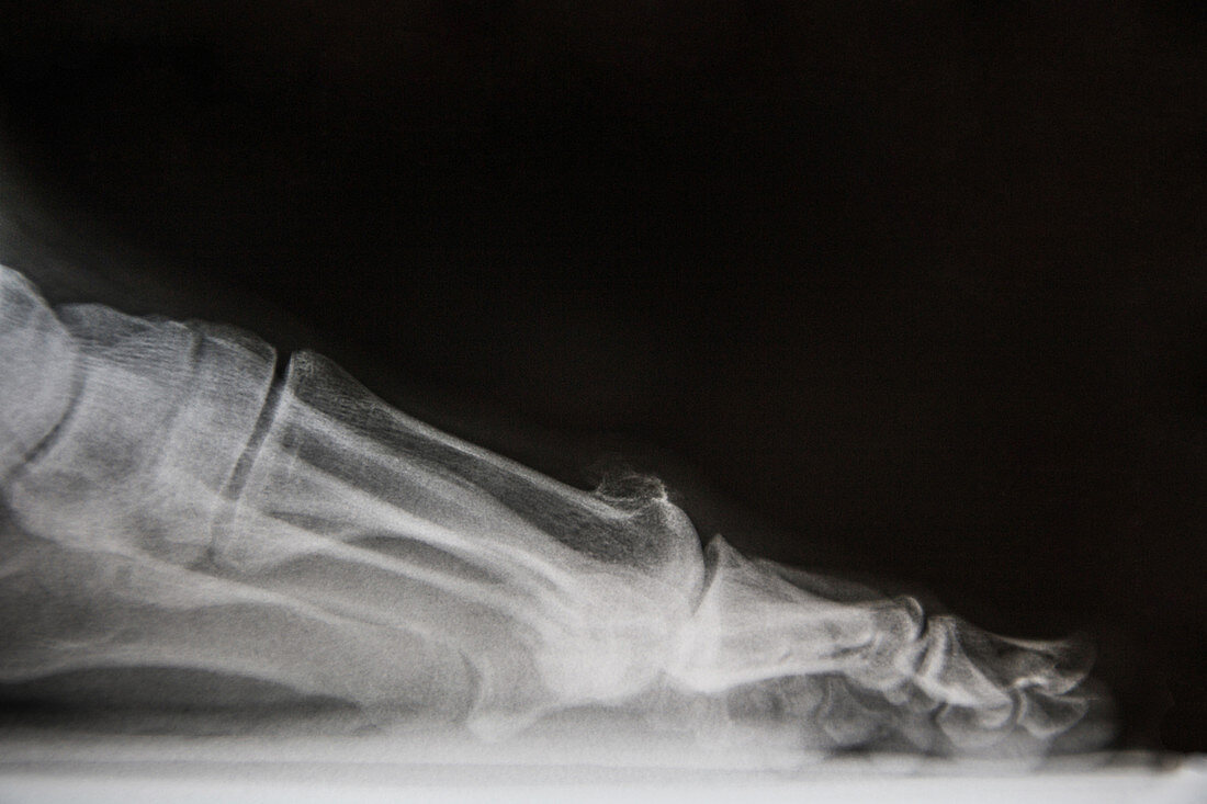Osteoarthritis of Big Toe,X-ray