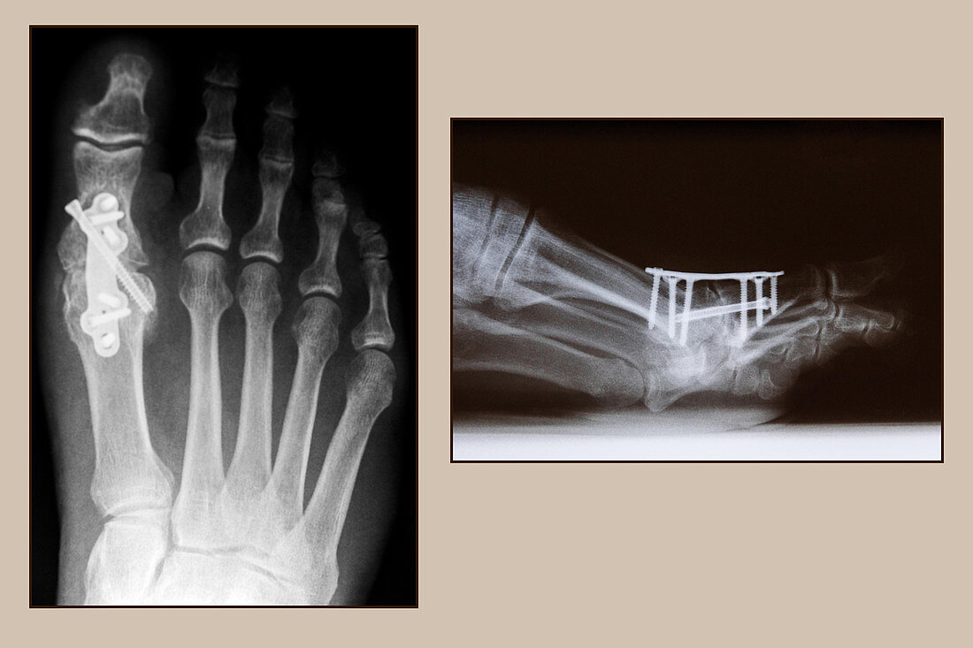 Arthrodesis Operation,X-rays