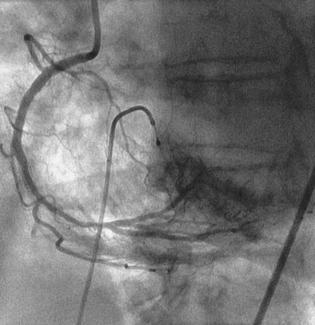 Heart Angiogram After Stent 2 of 2