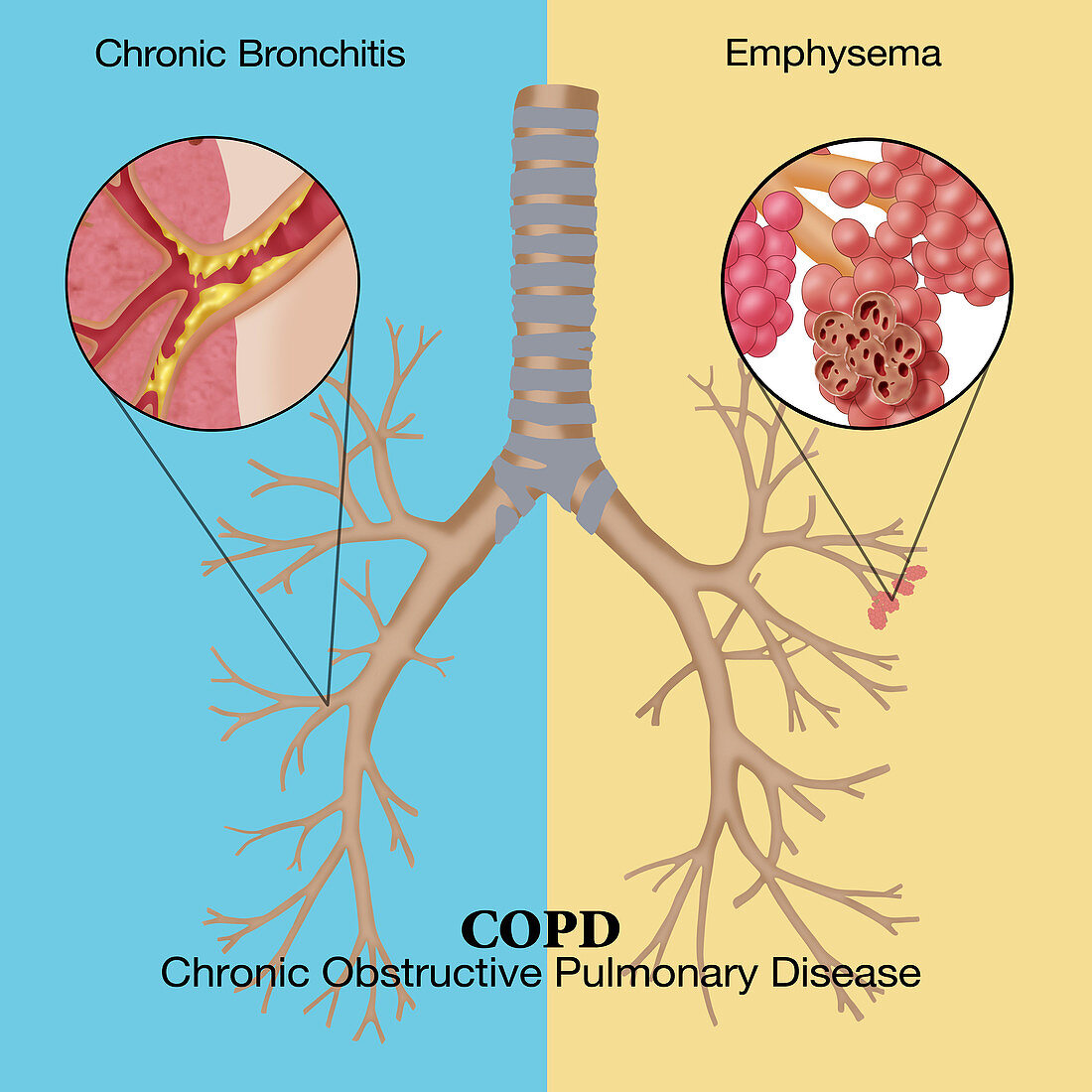 Chronic Pulmonary Disease,Illustration