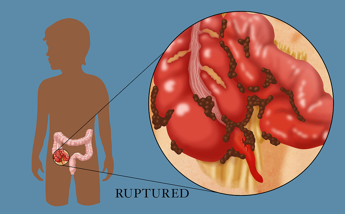 Ruptured Appendix,Illustration