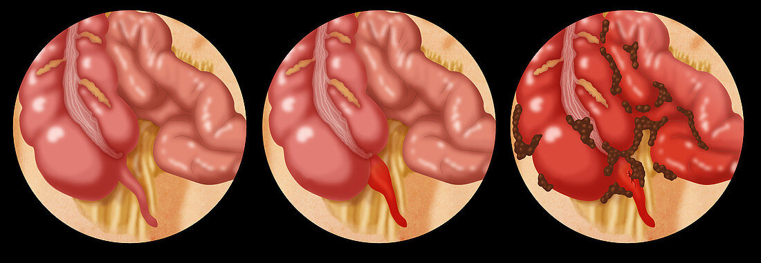 Appendicitis,Illustration