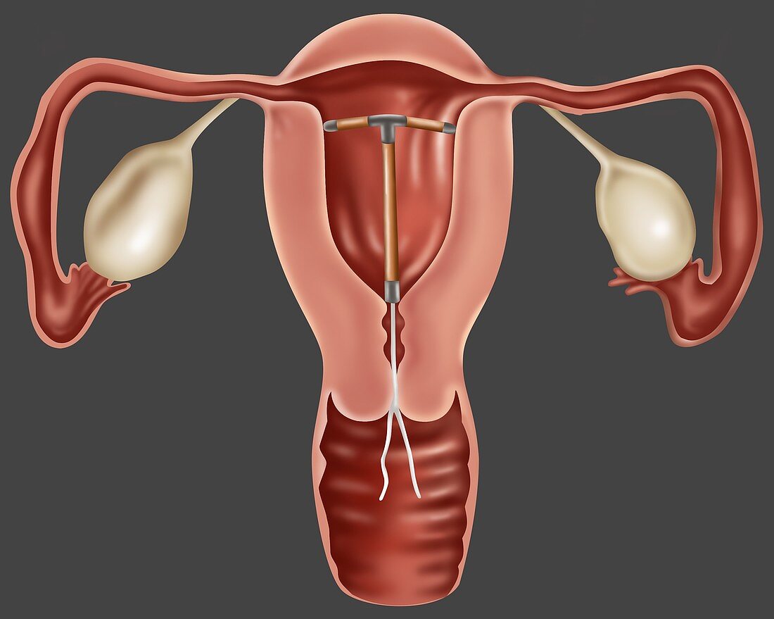 IUD Contraceptive,Illustration