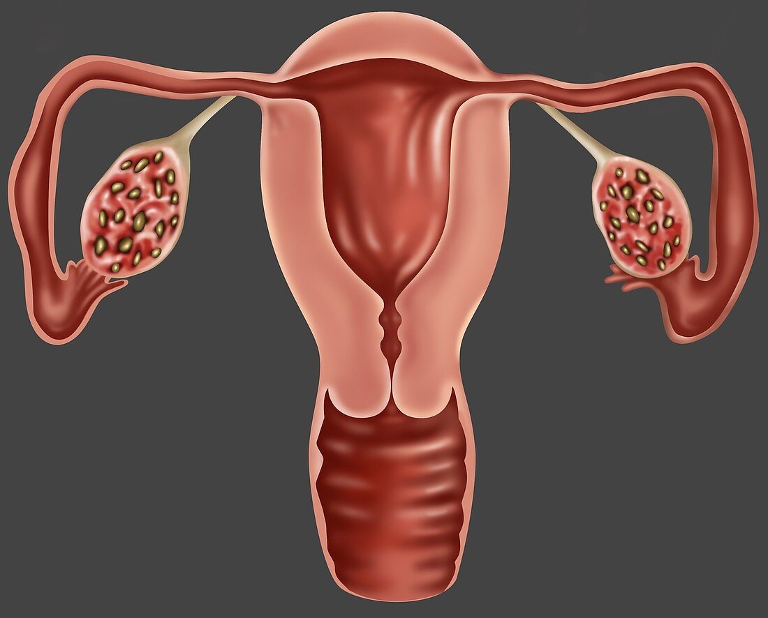 Polycystic Ovaries,Illustration