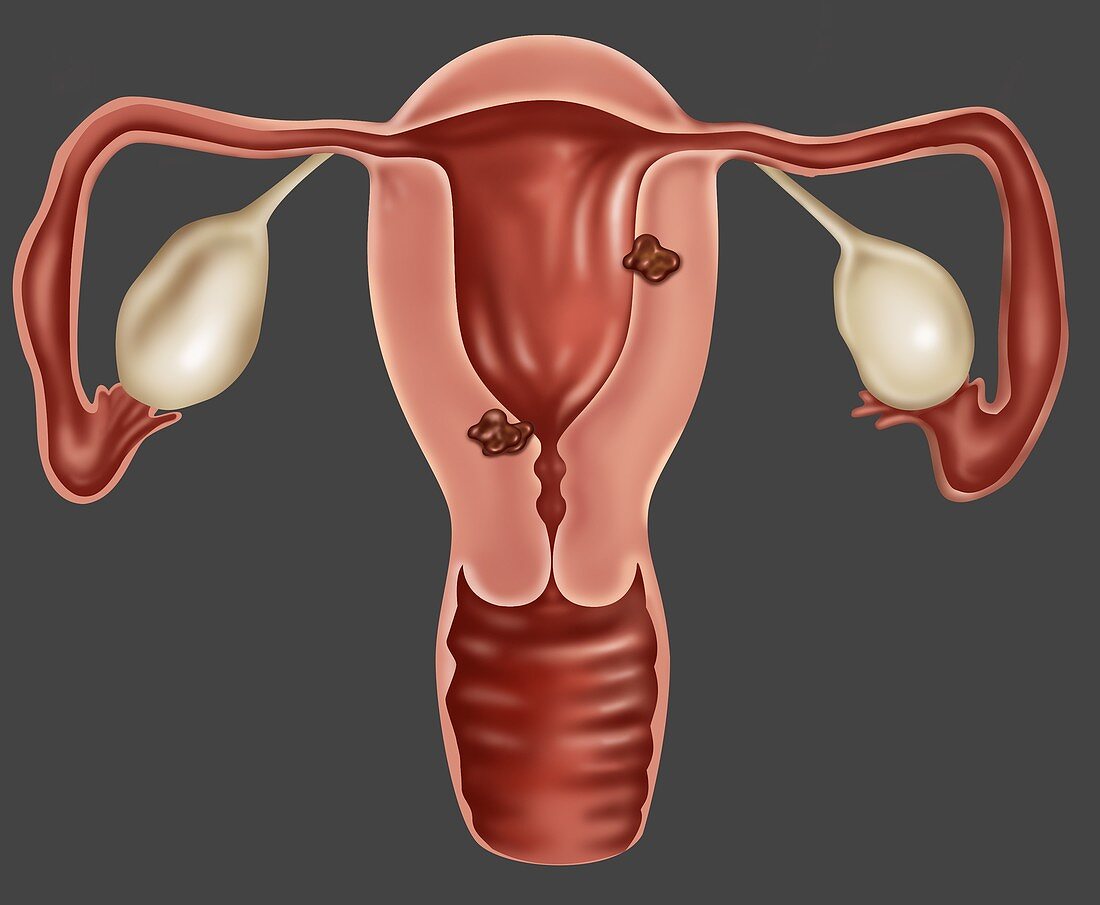 Endometrial Cancer,Illustration